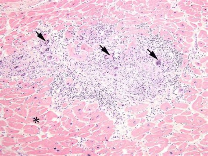 What do sarcoid granulomas look like?