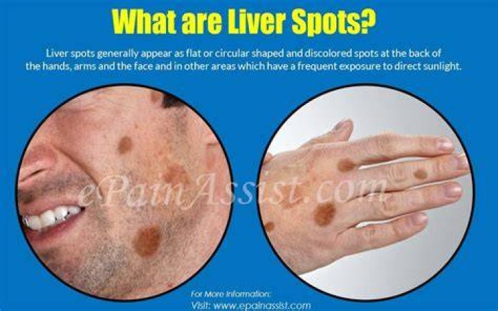 What does a liver spot look like?