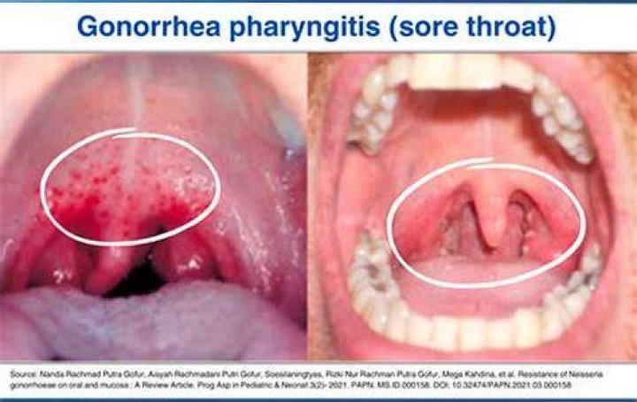 What does chlamydia in throat look like?