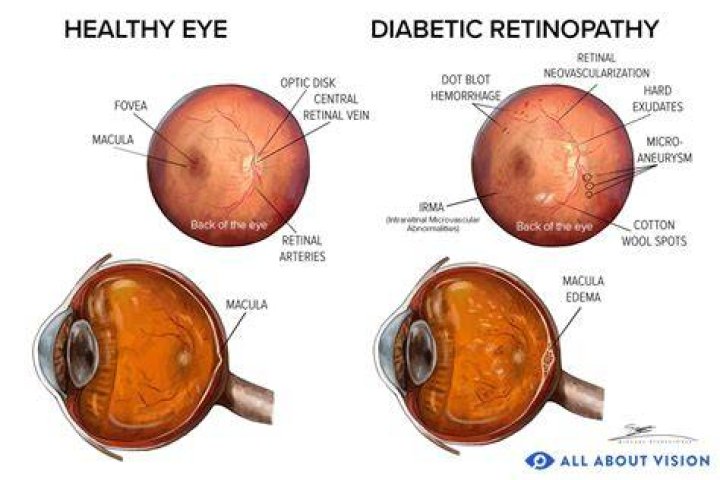 What does diabetic eye damage look like?