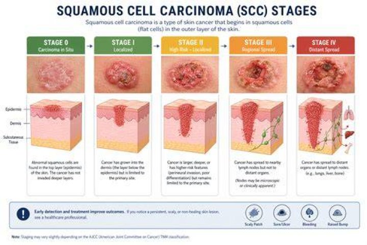 What does squamous cell carcinoma look like on the scalp?