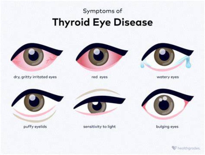 What eye condition is associated with hypothyroidism?