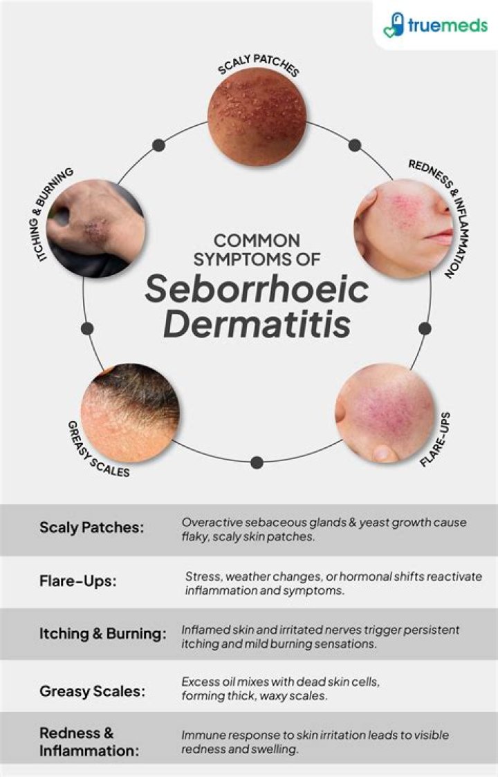 What happens if seborrheic dermatitis is left untreated?
