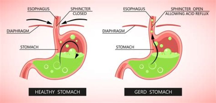 What happens if stomach acid gets in your throat?