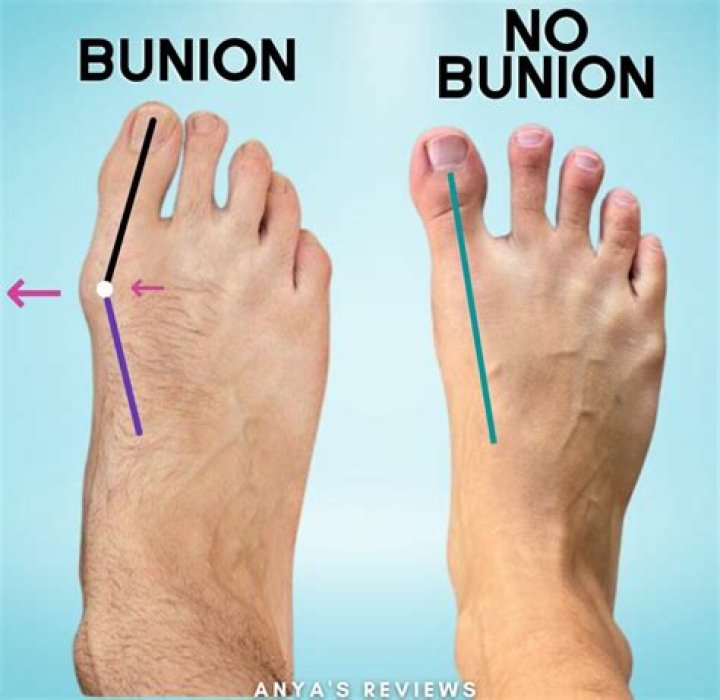What happens if you don't fix your bunion?