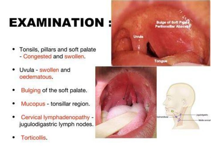 What is a Quincy throat?