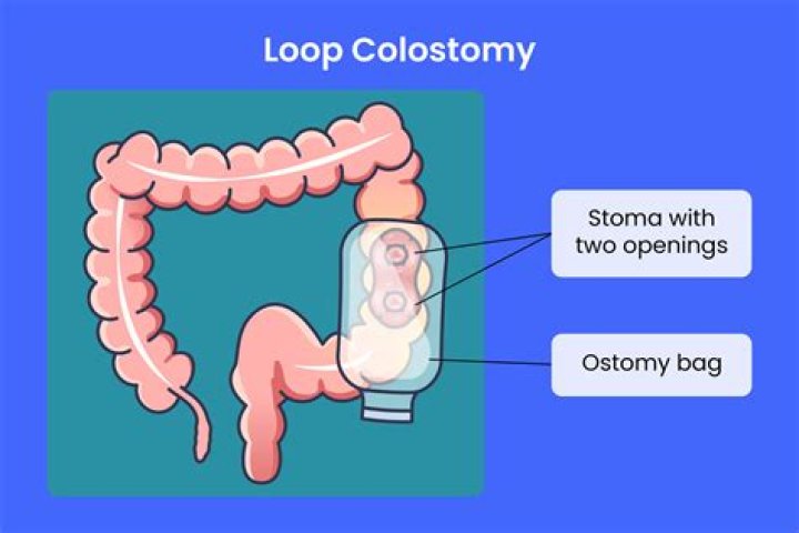 What is it like living with a stoma bag?