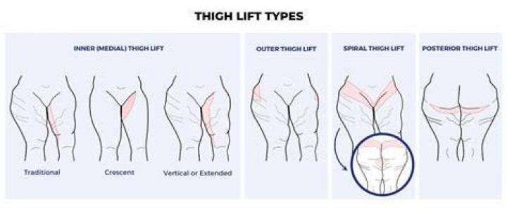 What is scarless thigh lift?