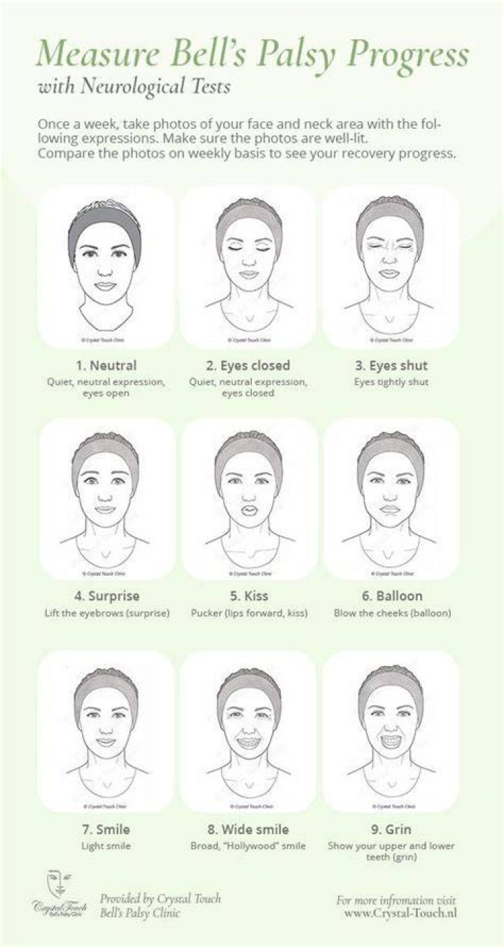 What is the normal recovery time for Bell's palsy?