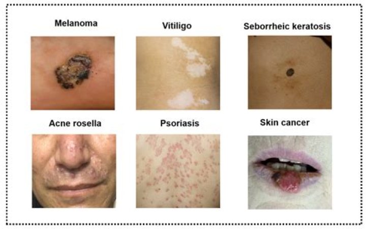 What skin disease is V?
