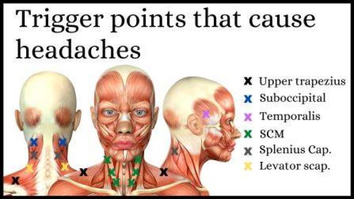 What trigger points cause headaches?