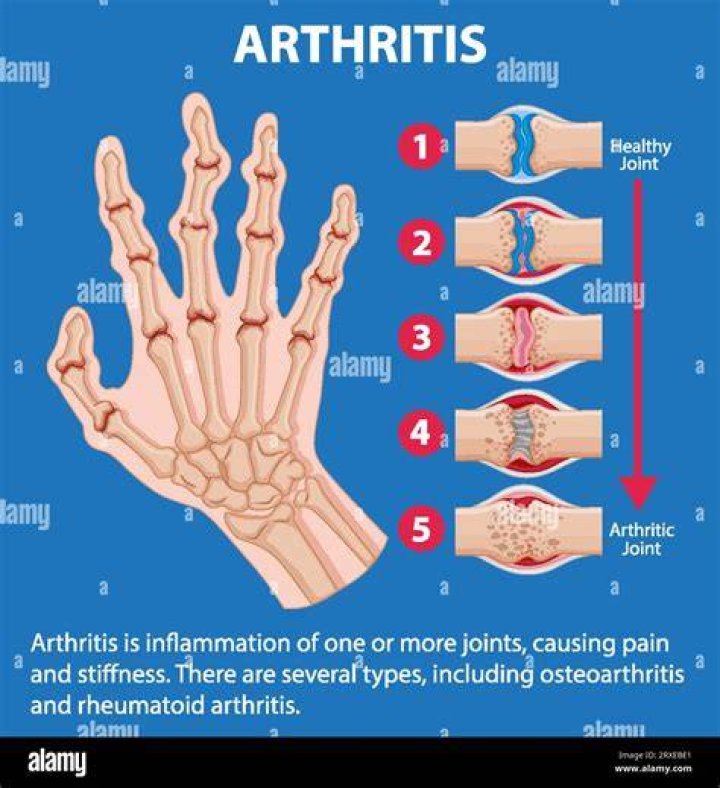 What type of arthritis is hereditary?