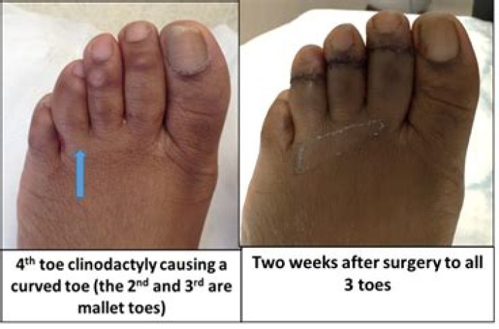Why are my toes curved sideways?