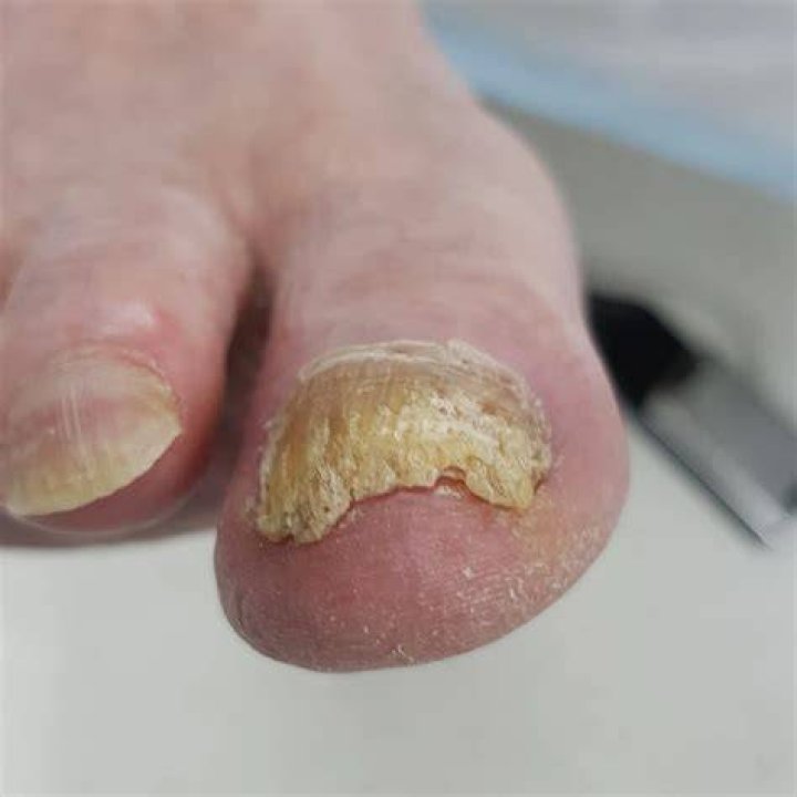 Why do I have thick stuff under my toenails?