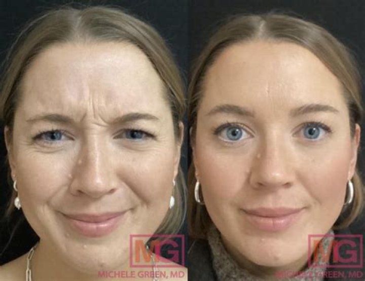 Why do I still have wrinkles after Botox?