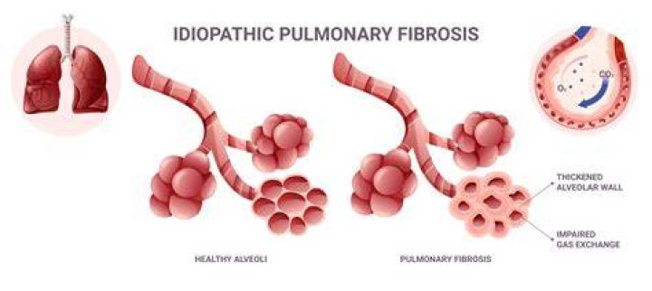 Will a lung transplant cure IPF?