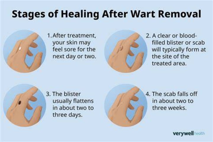 Will I have warts forever?