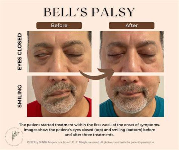 Will my eye go back to normal after Bell's palsy?